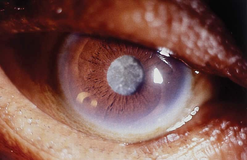 C’est quoi la cataracte secondaire ?